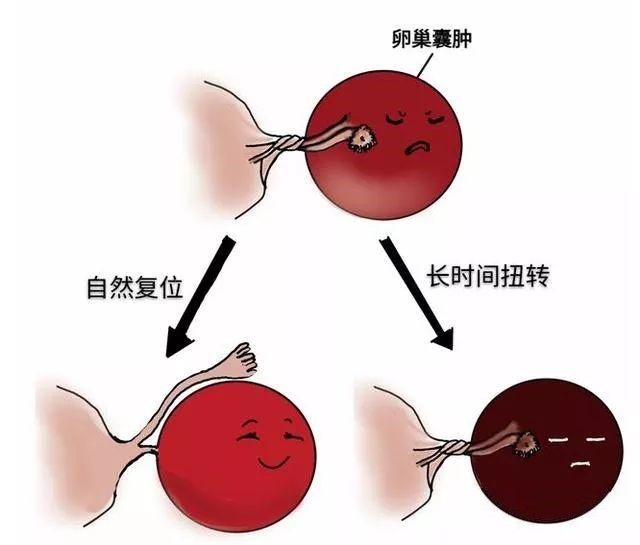 囊肿巧克力 囊肿_巧克力囊肿_脚踝 囊肿 微波理疗仪 治疗囊肿