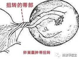 巧克力囊肿