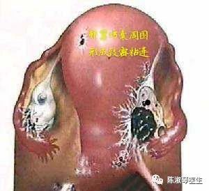 巧克力囊肿