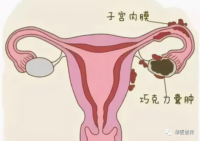 巧克力囊肿_脚踝 囊肿 微波理疗仪 治疗囊肿_好丽友q蒂摩卡 巧克力味 榛子巧克力