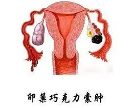 巧克力囊肿_好丽友q蒂摩卡 巧克力味 榛子巧克力_脚踝 囊肿 微波理疗仪 治疗囊肿