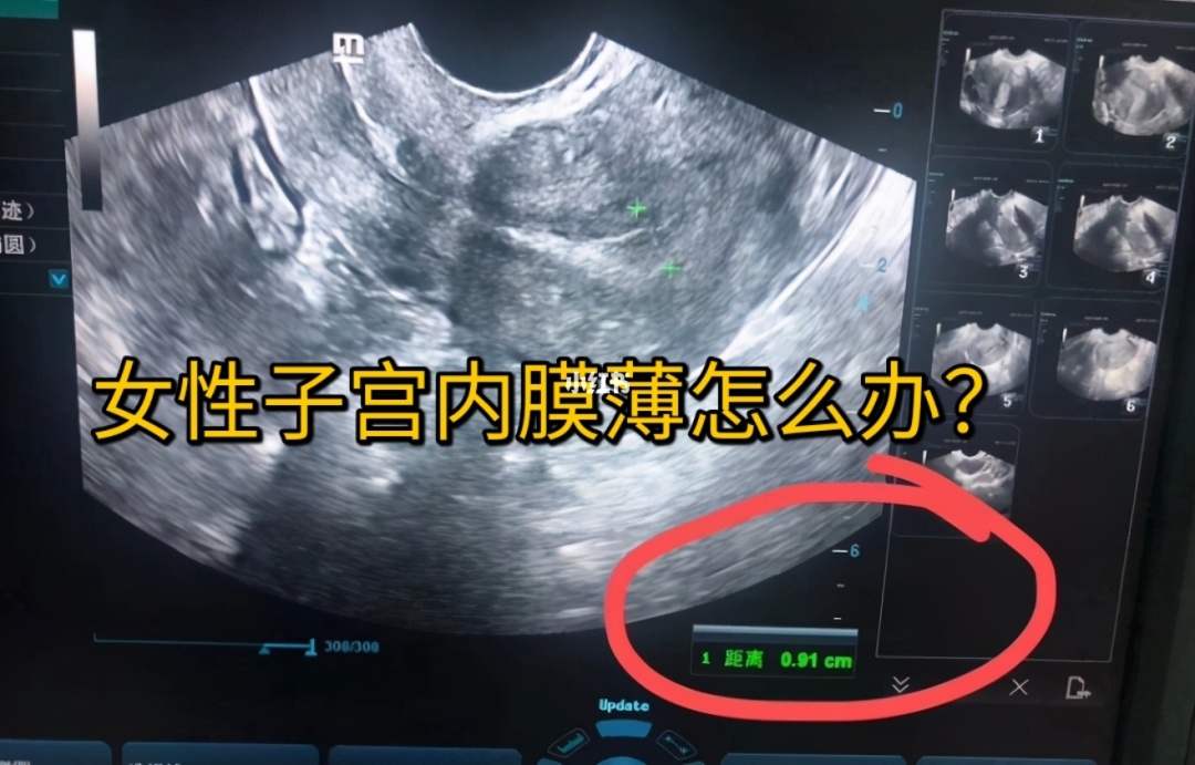 子宫内膜薄_子宫没有内膜有月经吗_内膜正常子宫会粘连