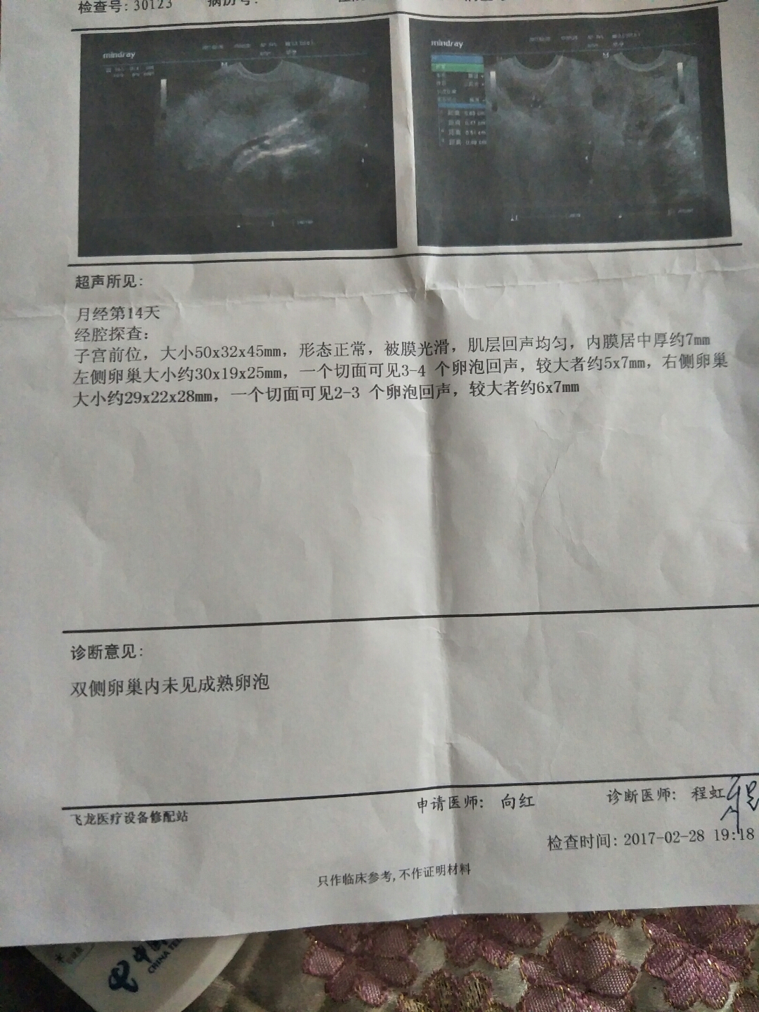 卵泡期卵泡多大_卵泡期用洗手液影响卵泡发育吗_窦卵泡计数