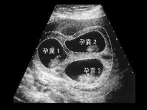 多胎妊娠