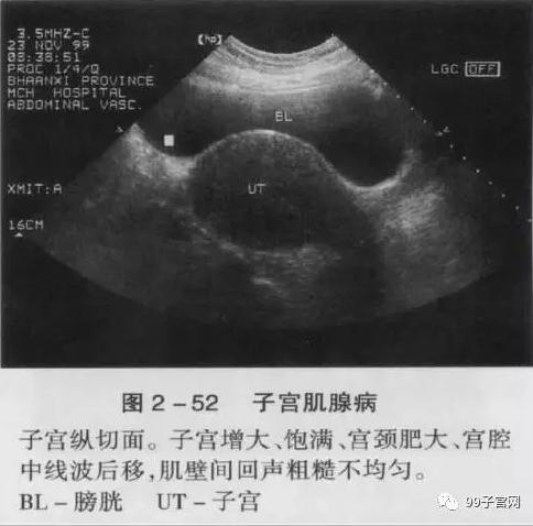 图片真的血腥!子宫腺肌症的真实面目