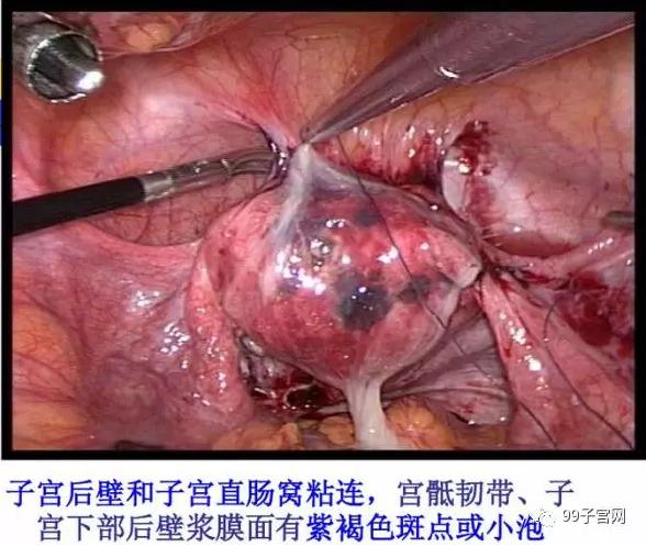 图片真的血腥!子宫腺肌症的真实面目