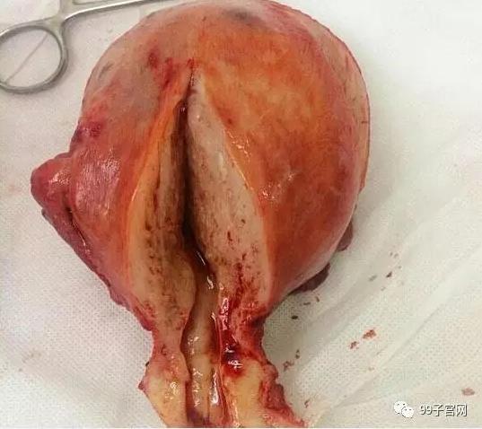 图片真的血腥!子宫腺肌症的真实面目