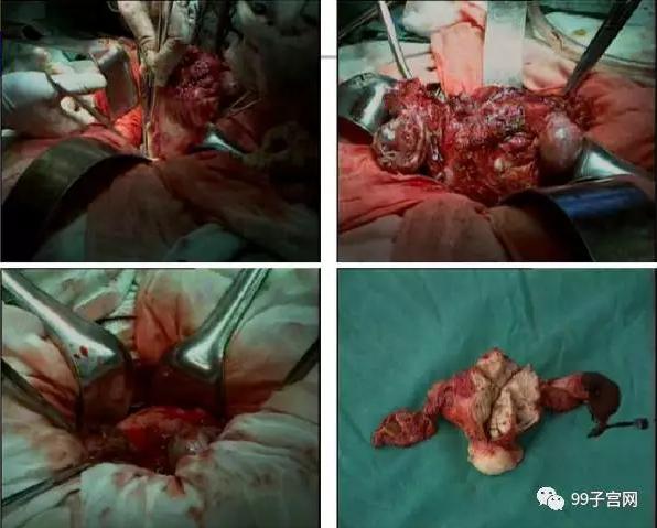 图片真的血腥!子宫腺肌症的真实面目