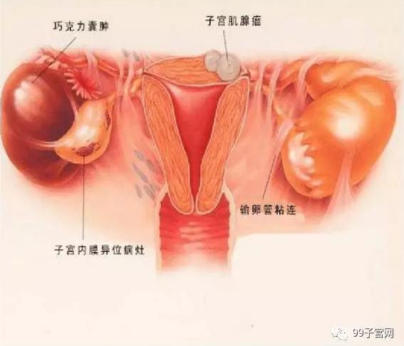 图片真的血腥!子宫腺肌症的真实面目