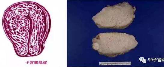 图片真的血腥!子宫腺肌症的真实面目