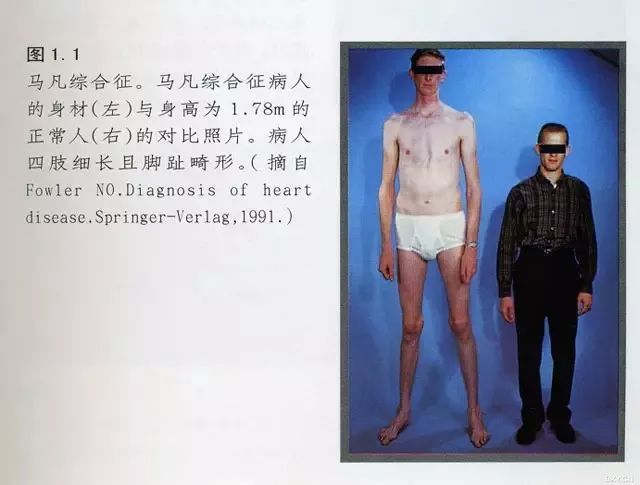 马凡氏综合症