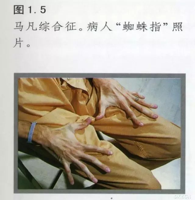 马凡氏综合症