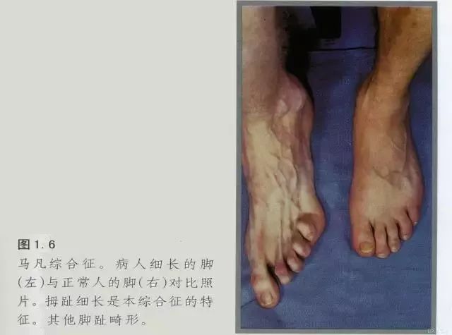 马凡氏综合症