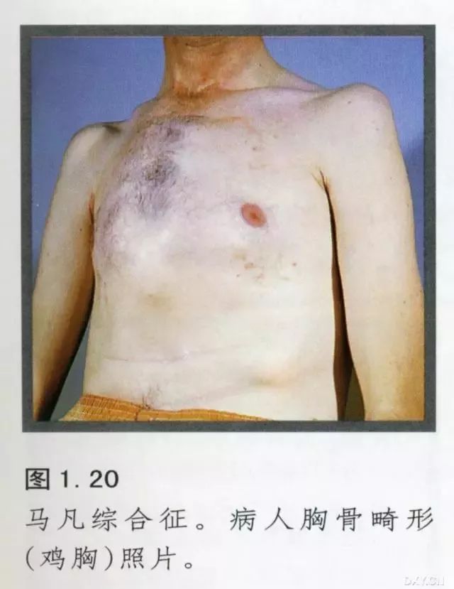 马凡氏综合症