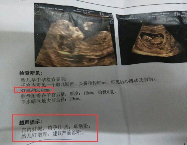 产科检查 nt_产科检查nt_nt检查