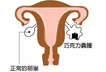 巧克力 囊肿_皮样囊肿或皮脂腺囊肿图片_巧克力囊肿