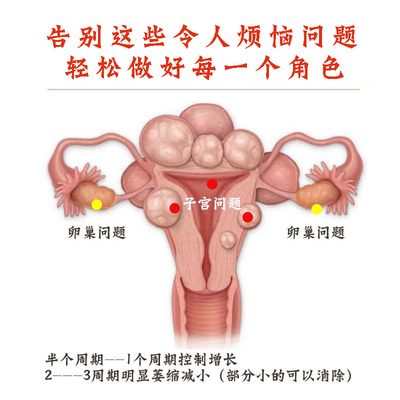 巧克力囊肿_双肾多发囊肿左侧伴钙囊肿_囊肿巧克力 囊肿