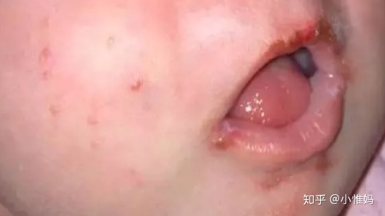 单纯疱疹病毒_呼吸道病毒 单纯疱疹_单纯疱疹