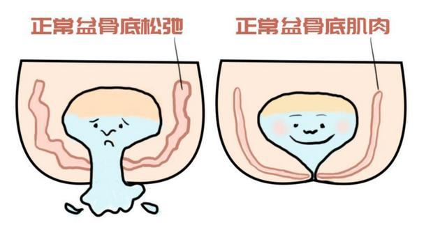 产后康复盆底肌_医院盆底肌康复_盆底肌修复