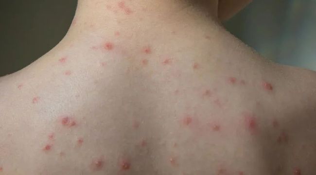 单纯疱疹病毒_单纯疱疹病毒的治疗方法_单纯疱疹Ⅰ/Ⅱ型病毒igm抗体
