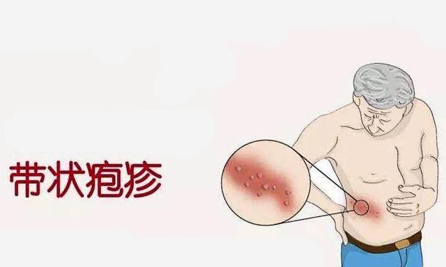 单纯疱疹病毒