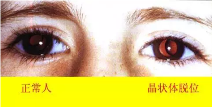 马凡氏综合症