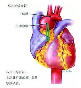 马凡氏综合症
