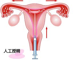 辅助生殖