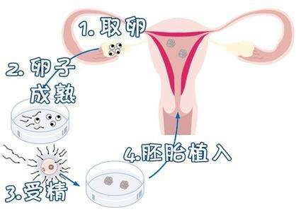 辅助生殖