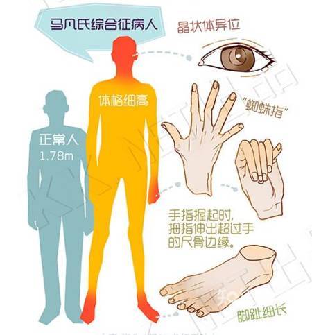 马凡氏综合症