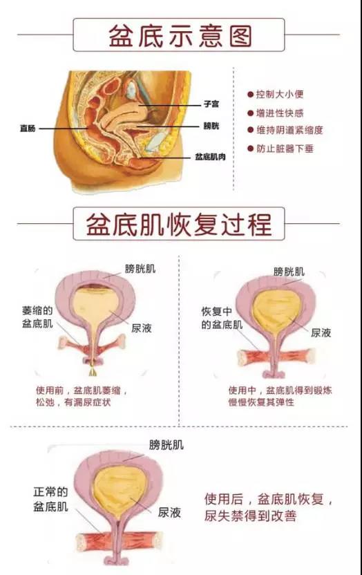 盆底肌康复治疗_盆底肌康复_盆底肌修复