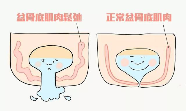 盆底肌康复治疗_盆底肌修复_盆底肌康复