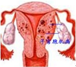 子宫腺肌症