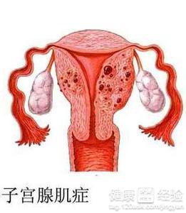 子宫腺肌症与腺肌瘤_子宫腺肌症的症状_子宫腺肌症