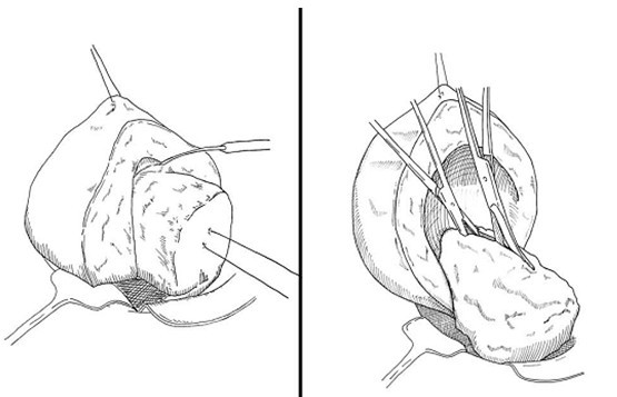子宫腺肌症