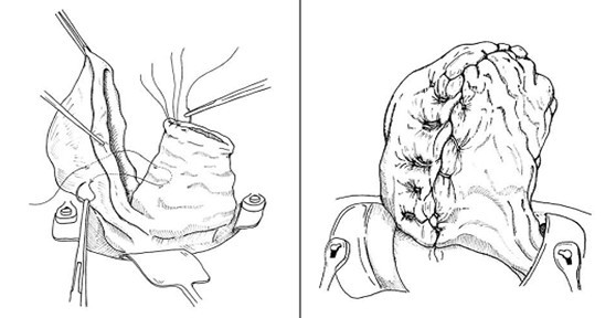 子宫腺肌症