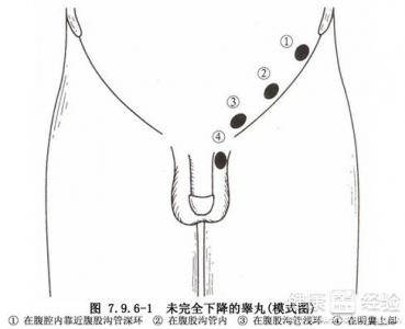 睾丸扭转/复位_睾丸扭转_睾丸扭转原因