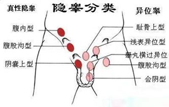 睾丸扭转原因_睾丸扭转/复位_睾丸扭转