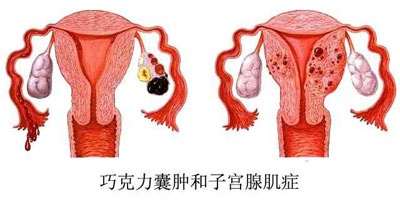 巧克力囊肿_可拉奥巧克力榛子瓦巧克力夹心蛋卷_脚踝 囊肿 微波理疗仪 治疗囊肿