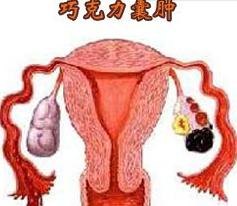 囊肿巧克力 囊肿_皮样囊肿或皮脂腺囊肿图片_巧克力囊肿