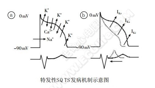 短QT综合征(短QT间期综合征、SQTS)(心血管 经典心电信息学综合征)