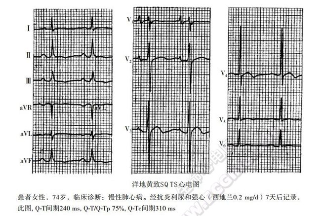 短QT综合征(短QT间期综合征、SQTS)(心血管 经典心电信息学综合征)