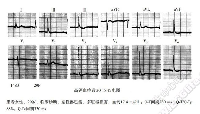 短QT综合征(短QT间期综合征、SQTS)(心血管 经典心电信息学综合征)