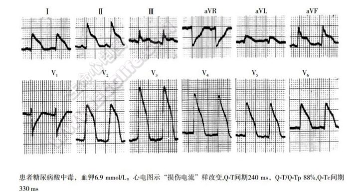 短QT综合征(短QT间期综合征、SQTS)(心血管 经典心电信息学综合征)