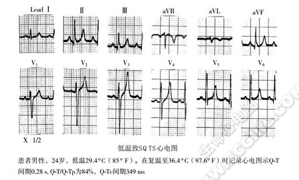 短QT综合征(短QT间期综合征、SQTS)(心血管 经典心电信息学综合征)