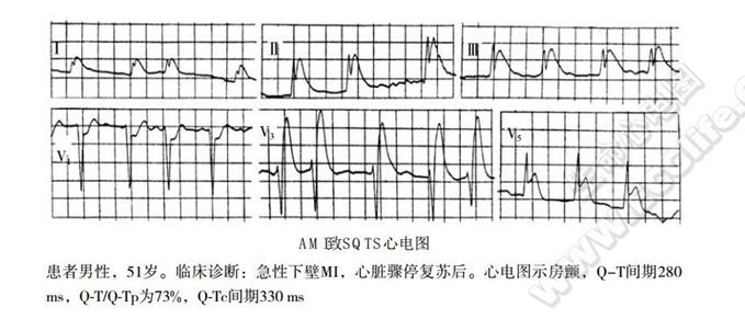 短QT综合征(短QT间期综合征、SQTS)(心血管 经典心电信息学综合征)