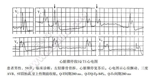短QT综合征(短QT间期综合征、SQTS)(心血管 经典心电信息学综合征)