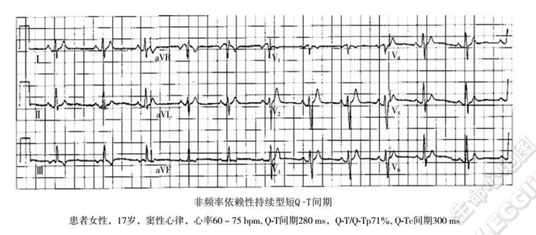 短QT综合征(短QT间期综合征、SQTS)(心血管 经典心电信息学综合征)
