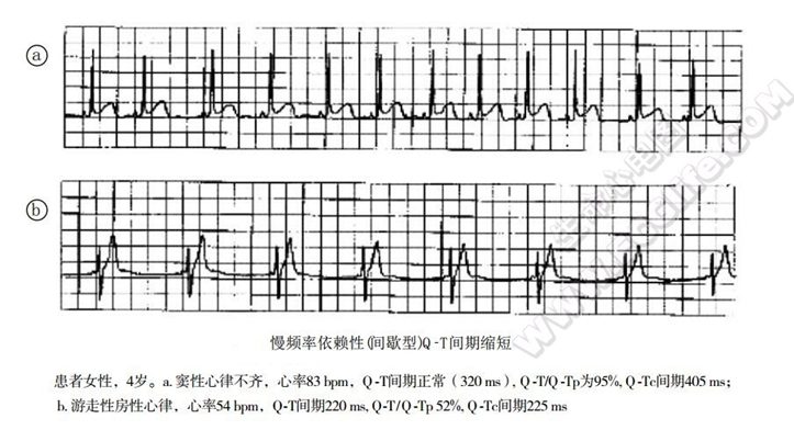 短QT综合征(短QT间期综合征、SQTS)(心血管 经典心电信息学综合征)