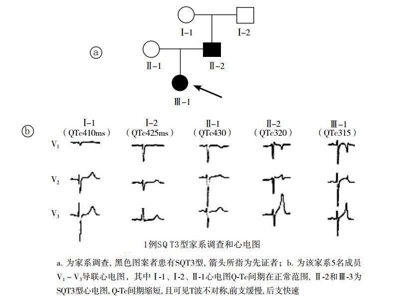 短QT综合征(短QT间期综合征、SQTS)(心血管 经典心电信息学综合征)